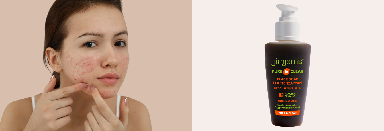 Pattanások nélkül: JimJams CLEAN & MATT Fekete szappan