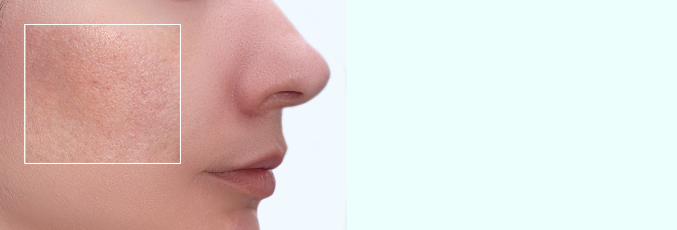 A zsíros bőr ápolása